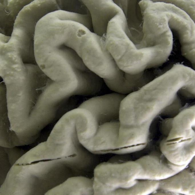 A gene long thought to just raise the risk for Alzheimer's may cause some cases